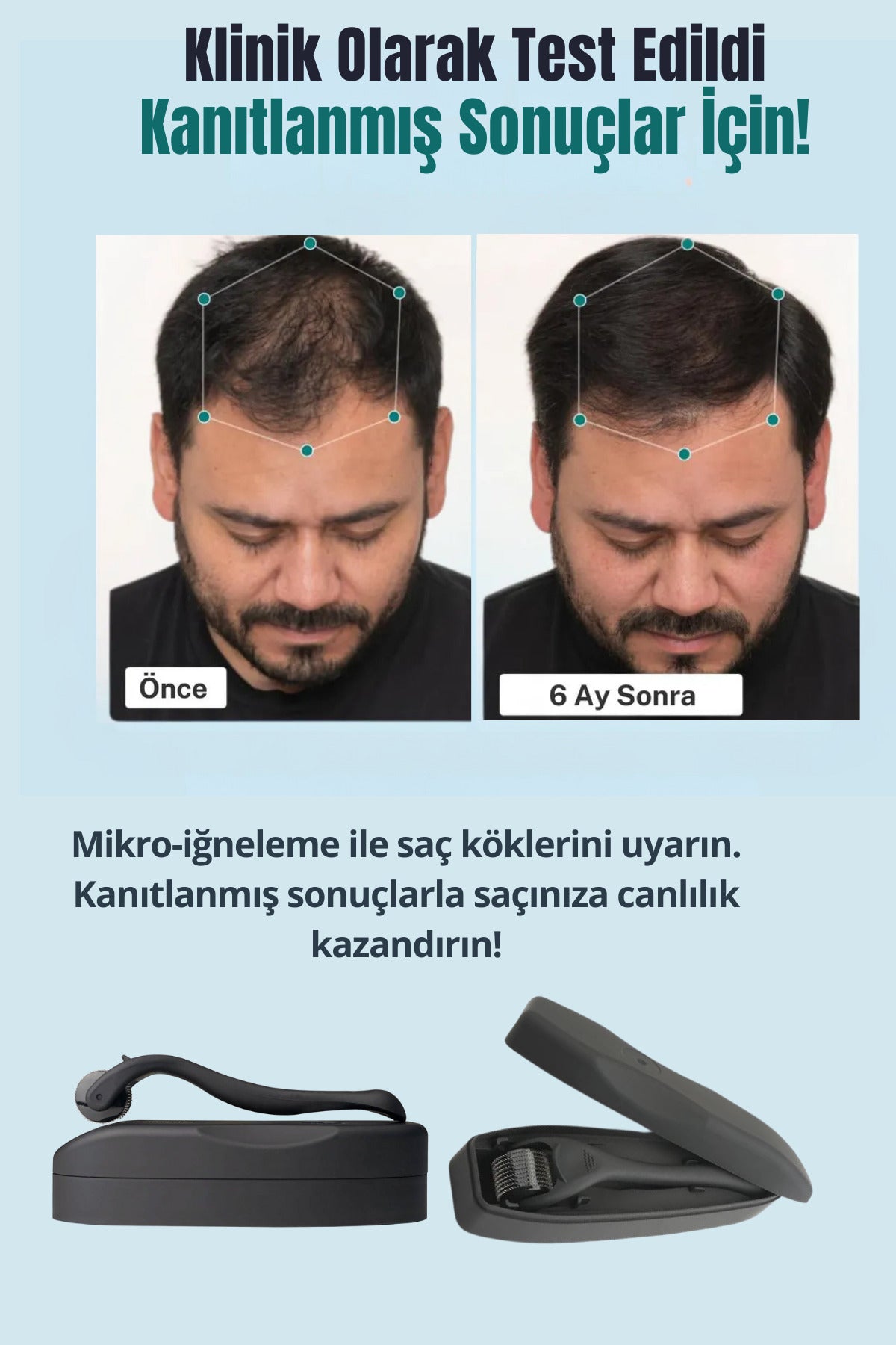 540 İğneli Titanyum Uçlu 0.75 mm Seyrek Saç ve Yüz Bakım Dermarolleri