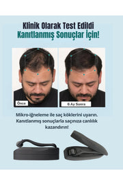 540 İğneli Titanyum Dermaroller 0.5 mm & Dezenfektan Seti