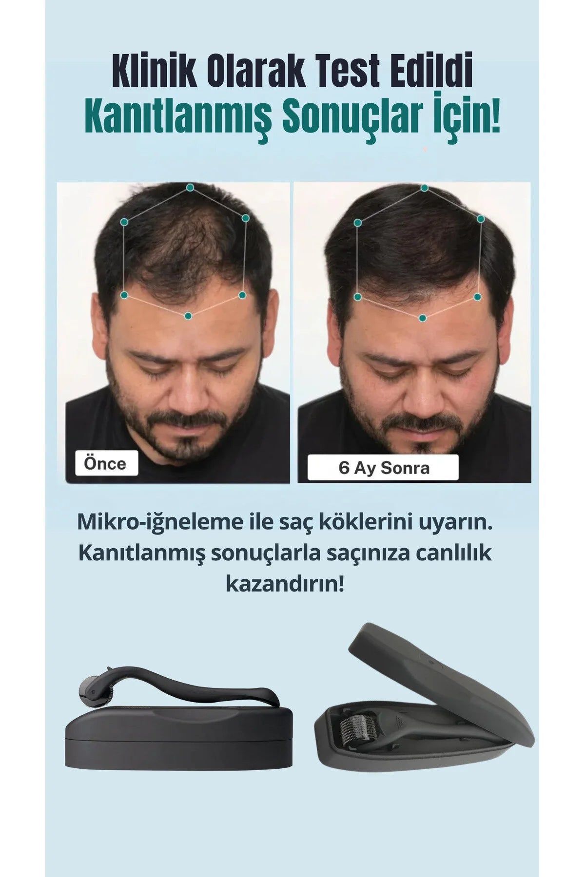 540 İğneli Titanyum Uçlu 0.5 mm Seyrek Saç ve Yüz Bakım Dermarolleri