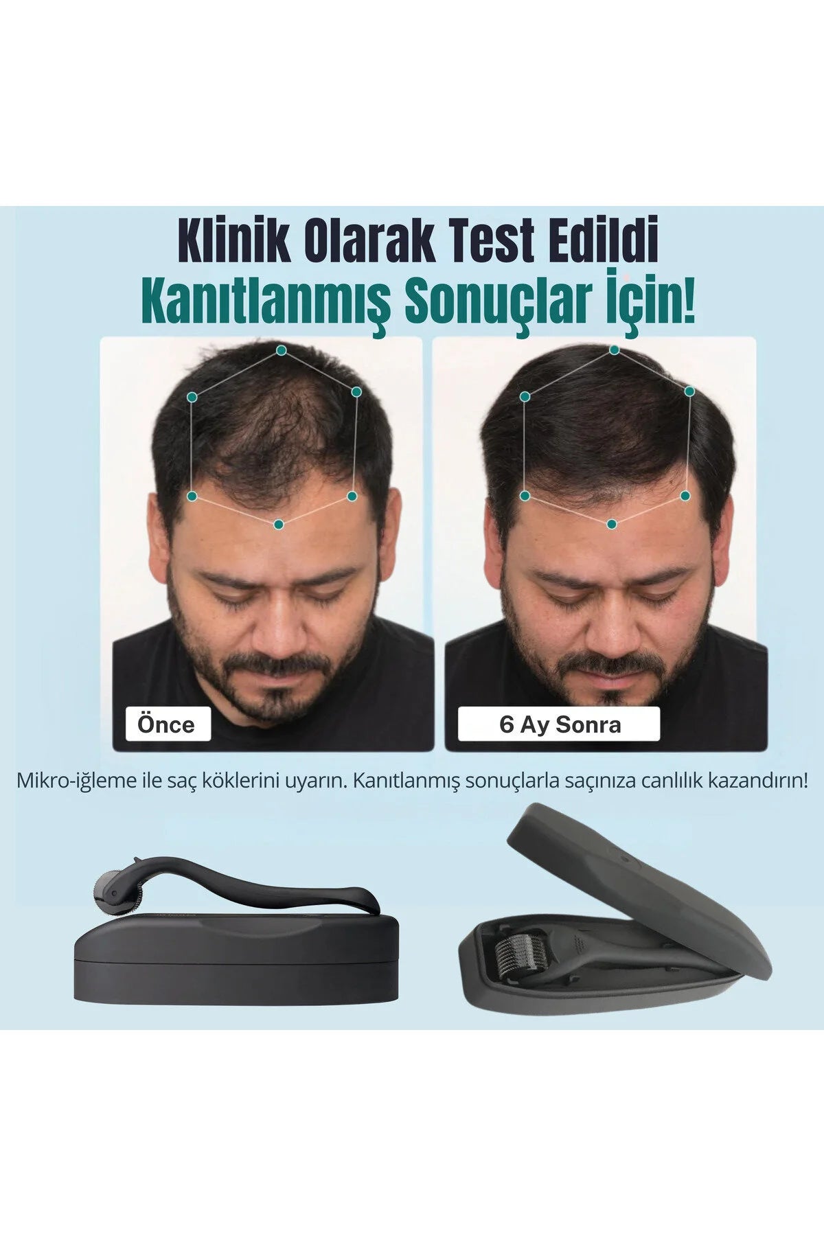 Titanyum Uçlu 540 İğneli Saç Sakal Çıkarma Ve Cilt Bakım Dermarolleri 1 mm